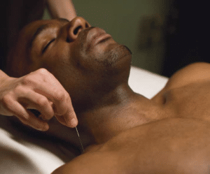 Black man getting acupuncture