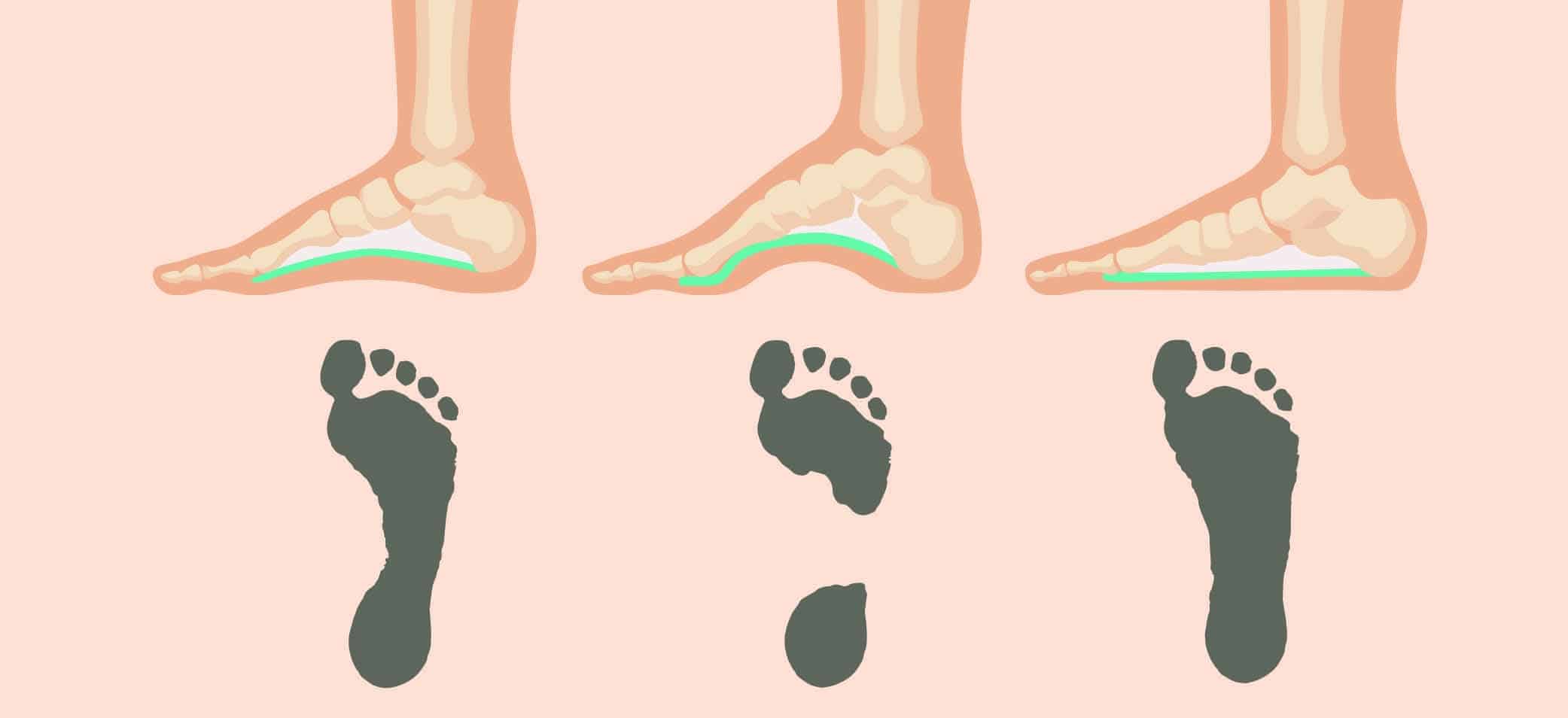 types of foot arches
